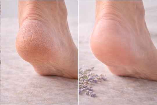 Heel rescue balm